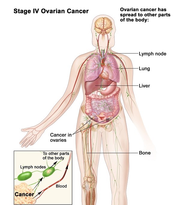 Các biện pháp cần thực hiện để chẩn đoán ung thư buồng trứng